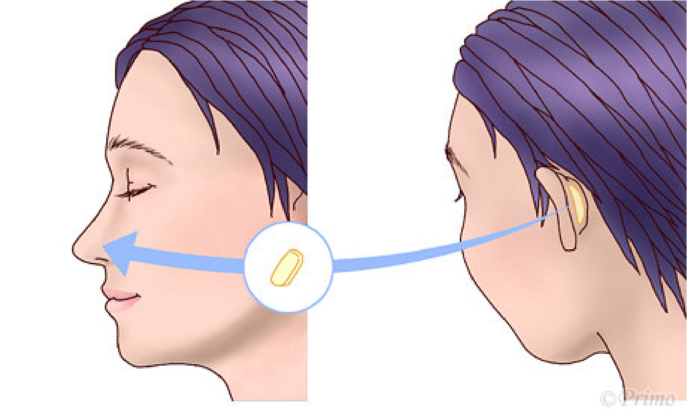 鼻中隔延長術手術の方法